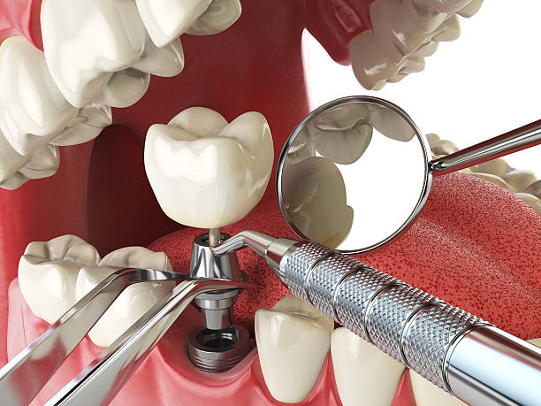 Best Emergency Root Canal Treatment in Zeigler, IL